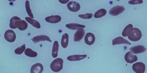 Drépanocytose : la thérapie génique offre de nouveaux espoirs pour les malades en Afrique