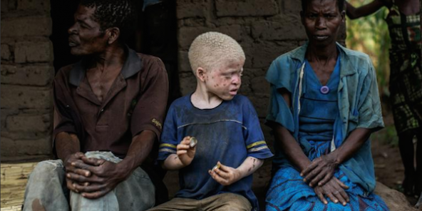 Un enfant albinos avec ses parents, le 17 avril 2015, dans le district de Machinga, dans le sud du Malawi.